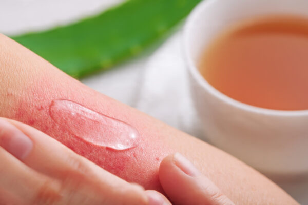 Healing skin irritation with a natural chamomile and aloe vera treatment.